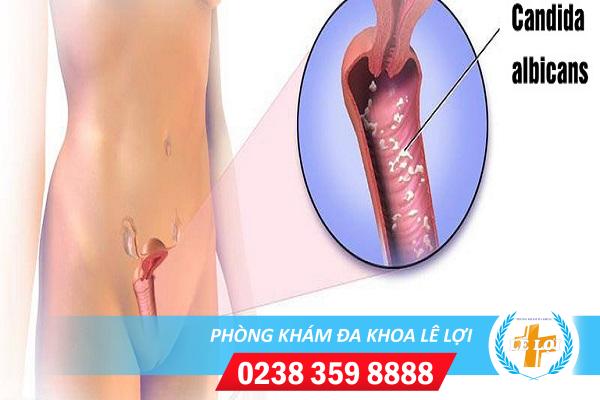 Nấm Candida – thủ phạm nguy hiểm gây viêm nhiễm vùng kín