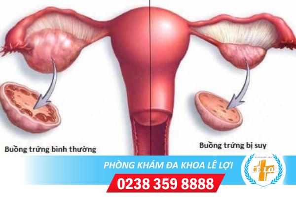 Những triệu chứng của bệnh suy buồng trứng sớm