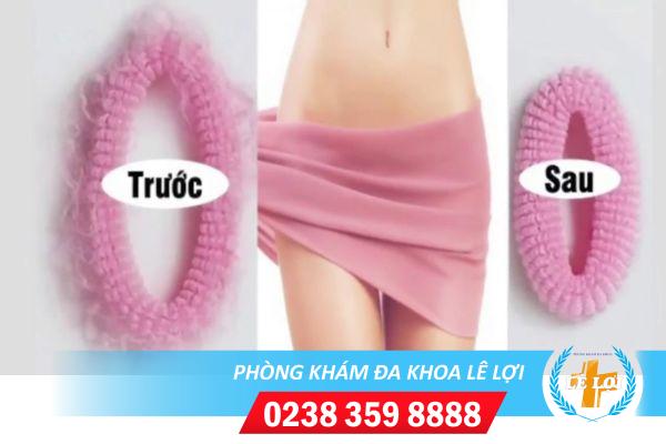 Thu hẹp âm đạo – Cách cải thiện hạnh phúc gia đình chị em