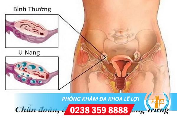 Làm sao nhận biết bệnh u nang buồng trứng?