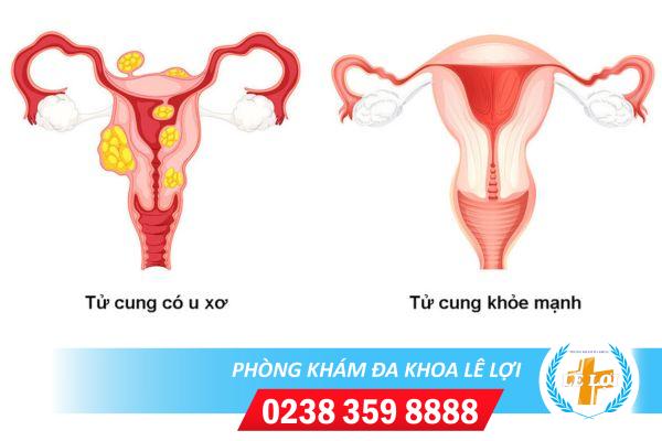 Các tác hại phì đại cổ tử cung đối với nữ giới là gì?