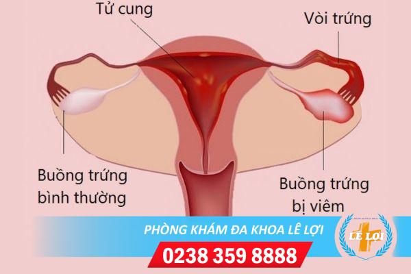 Như thế nào là bệnh viêm buồng trứng?