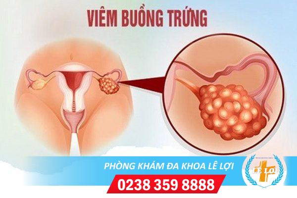 Hỗ trợ chữa viêm buồng trứng uy tín ở đâu?