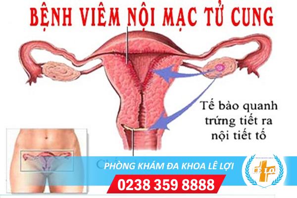 Những điều chị em cần biết về viêm nội mạc tử cung