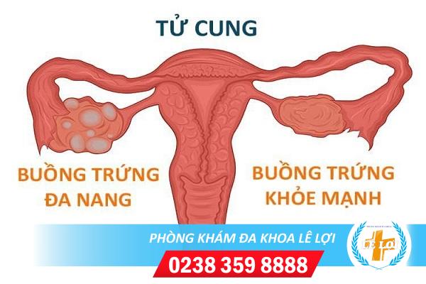 Những tác hại của đa nang buồng trứng mà bạn chưa biết?