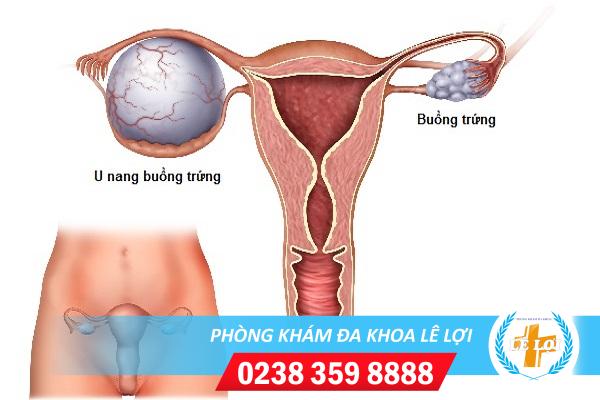 Tác hại của u nang buồng trứng