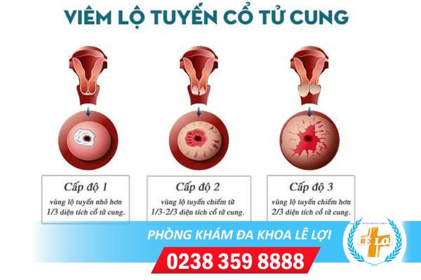 Hỗ trợ điều trị viêm lộ tuyến cổ tử cung bằng cách nào?