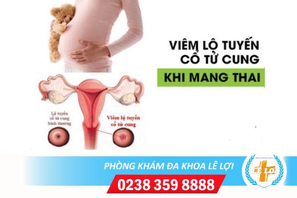 Làm sao nhận biết viêm lộ tuyến khi mang thai?