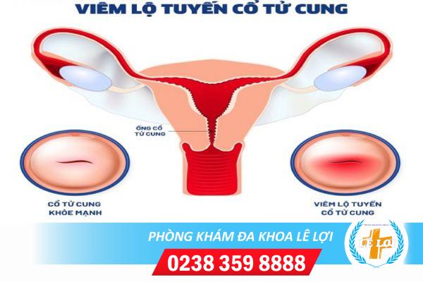 Phương pháp đốt điện viêm lộ tuyến cổ tử cung có hiệu quả không?