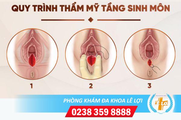 Địa chỉ thu hẹp tầng sinh môn uy tín tại Vinh