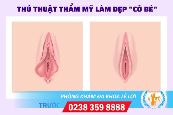 Hé Lộ Địa Chỉ Cắt Môi Bé Uy Tín, An Toàn Nhất Tại Vinh