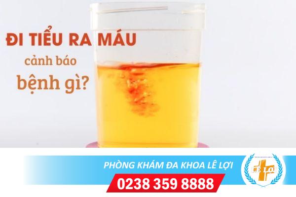 Đái Ra Máu Là Bệnh Gì Ở Phụ Nữ? Đừng Xem Thường Triệu Chứng Kẻo Bệnh Thêm Nặng