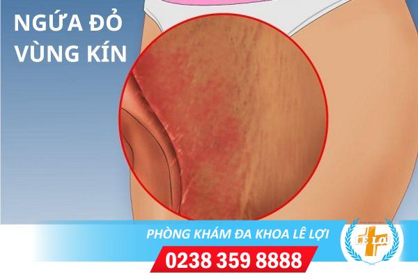 Nguyên nhân và cách xử lý ngứa đỏ vùng kín