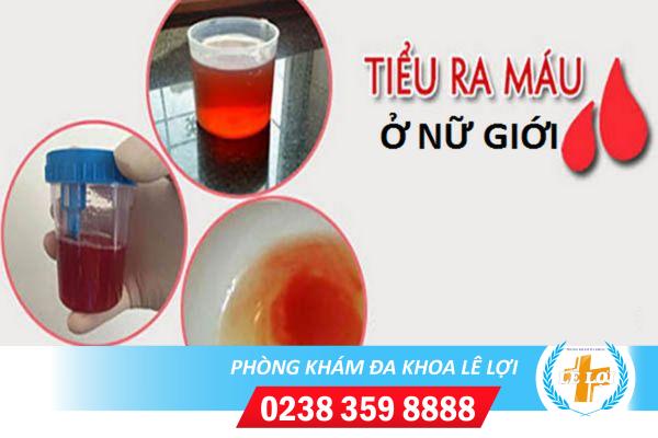 Đái ra máu ở nữ giới – cảnh báo bệnh nguy hiểm