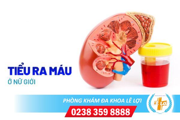 Đi tiểu buốt ra máu – dấu hiệu không nên xem thường