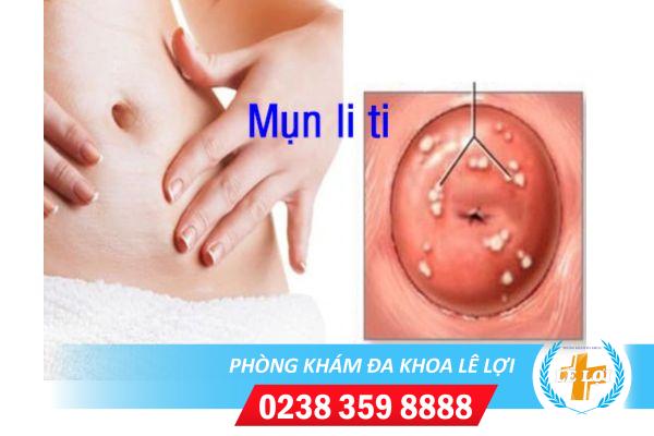 Nổi Mụn Ở Cổ Tử Cung Là Bệnh Gì