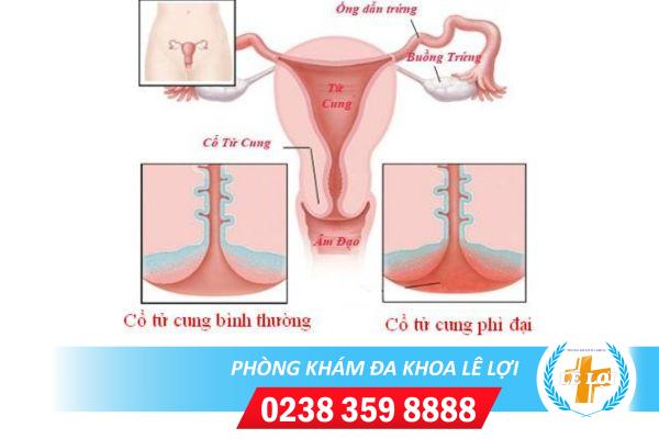 Phì Đại Cổ Tử Cung Là Bệnh Gì