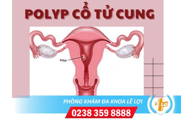 Nguyên Nhân Và Nguy Hại Của Polyp Cổ Tử Cung Đối Với Sức Khỏe Nữ Giới