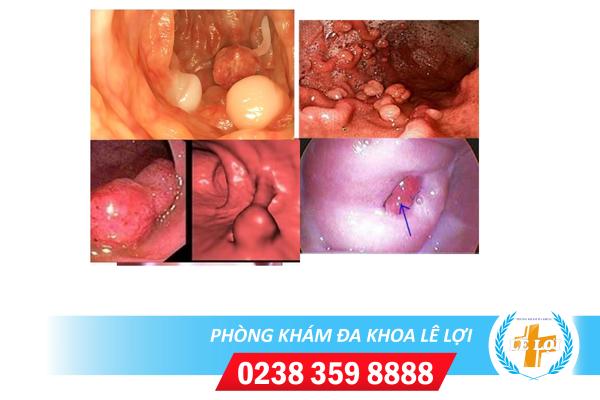 polyp-co-tu-cung-nguy-hiem-khong