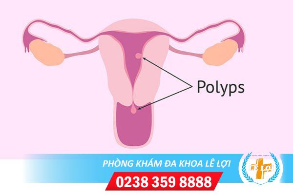 Những phương pháp điều trị Polyp cổ tử cung hiệu quả hiện nay