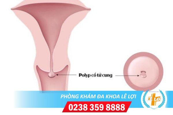 Chi Phí Điều Trị Polyp Cổ Tử Cung Hiện Nay Là Bao Nhiêu