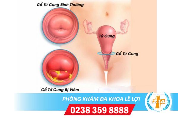 Nguy Hiểm Khó Lường Từ Viêm Cổ Tử Cung