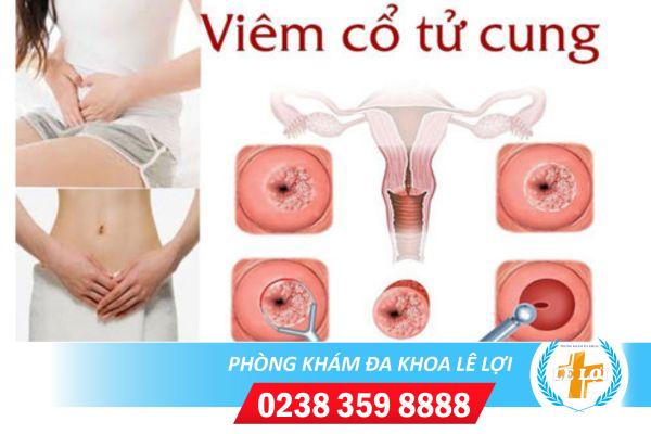 Thuốc Trị Viêm Cổ Tử Cung Hiệu Quả Cho Chị Em