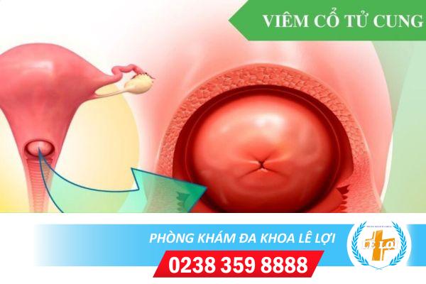 Điều Trị Viêm Cổ Tử Cung Hiệu Quả Bằng Phương Pháp Nào