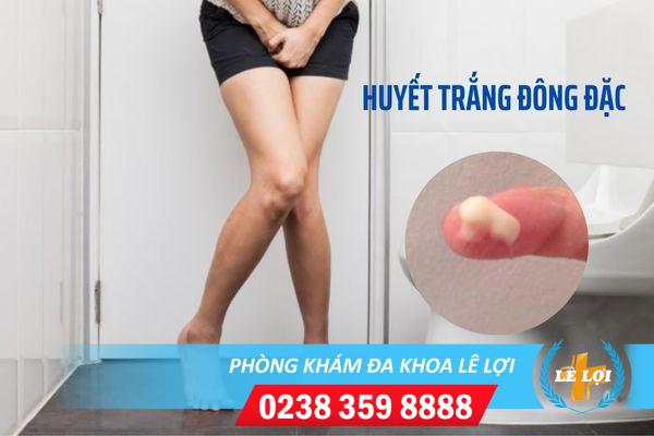 Địa chỉ điều trị huyết trắng đông đặc an toàn và hiệu quả hiện nay