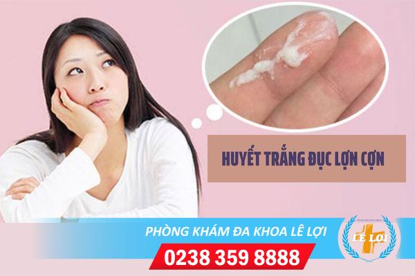 Chữa huyết trắng đục lợn cợn ở đâu hiệu quả?