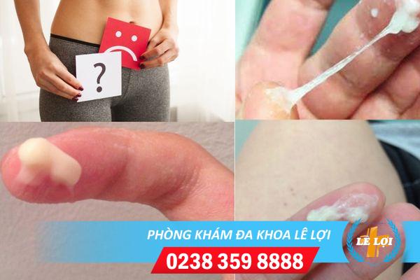 Huyết trắng đặc vón cục là biểu hiện của bệnh gì?