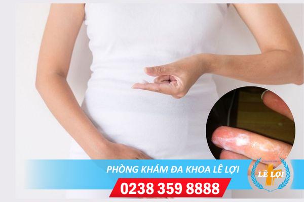 Vùng Kín Bị Ngứa Và Có Nhiều Dịch Trắng Vón Cục Là Bệnh Gì?