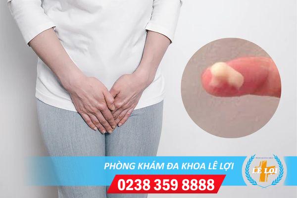 Huyết trắng đục ra nhiều là bị bệnh gì?