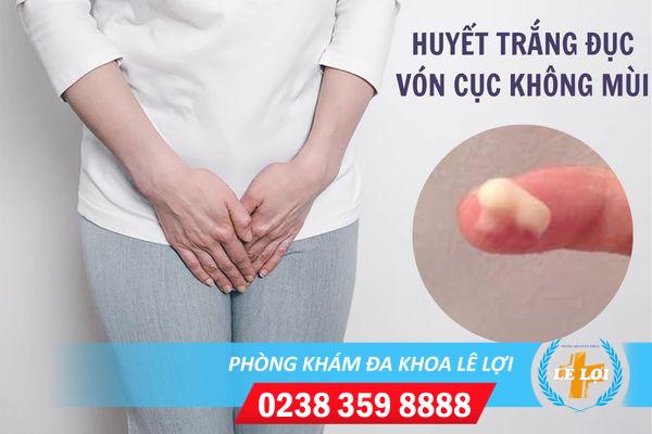 Huyết trắng vón cục không mùi cảnh báo bệnh gì?