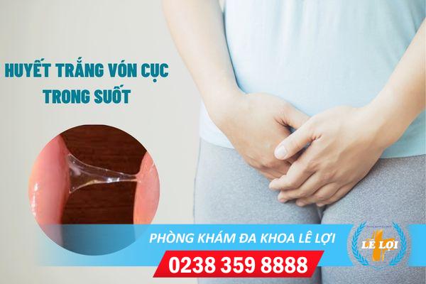 Cần làm gì khi huyết trắng vón cục trong suốt?