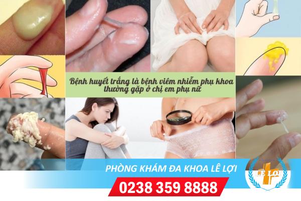 Những nguyên nhân huyết trắng ở nữ giới và cách khắc phục hiệu quả