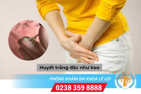 Điều trị huyết trắng như keo ở đâu hiệu quả?