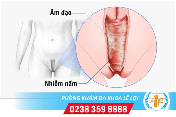 Thế nào là hiện tượng huyết trắng nhiễm nấm?