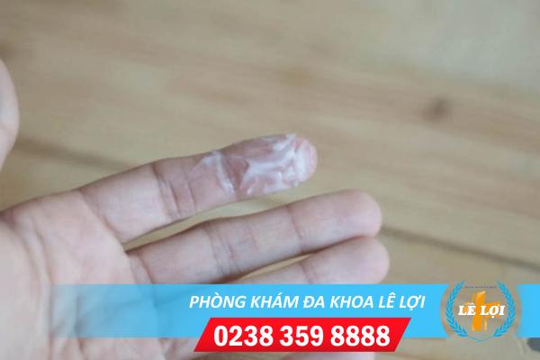 Huyết trắng nhiều là bệnh gì?