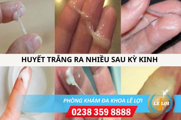 Huyết trắng ra nhiều sau kỳ kinh là bị bệnh gì?