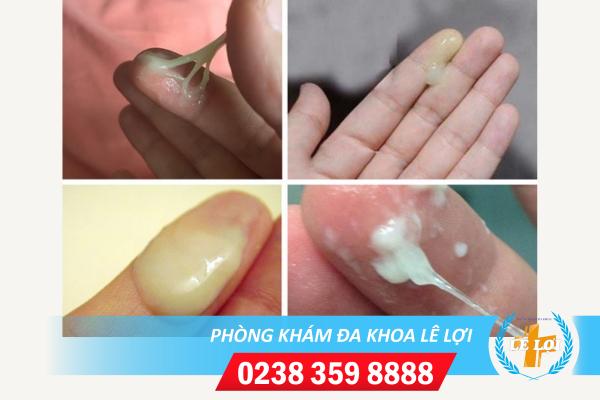 Huyết trắng ra nhiều vón cục và ngứa là vì đâu?