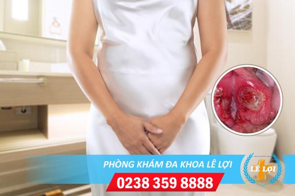 Lở Loét Âm Đạo – Dấu Hiệu Nguy Hiểm Chị Em Cần Cẩn Trọng