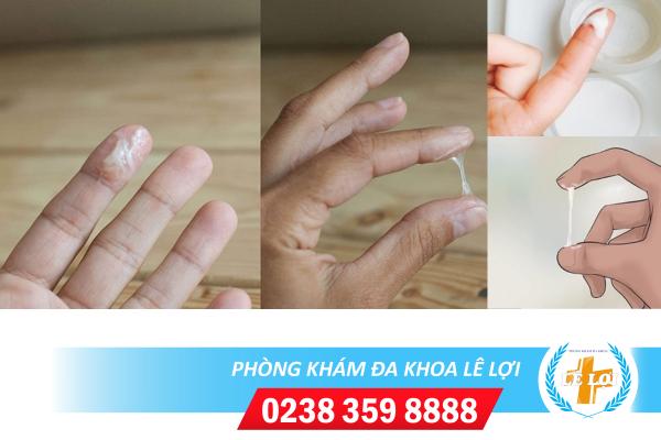 Cách khắc phục hiện tượng máu trắng hiệu quả hiện nay