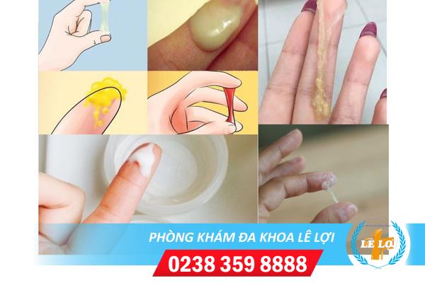 Cần làm gì khi có triệu chứng bệnh huyết trắng?