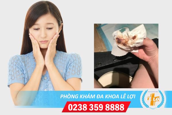 Huyết trắng màu nâu vón cục có phải mắc bệnh phụ khoa?