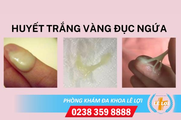 Huyết trắng vàng đục ngứa có đáng lo ngại không?