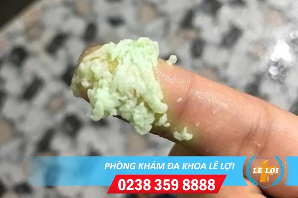 Làm gì khi huyết trắng vón cục màu xanh và ngứa?