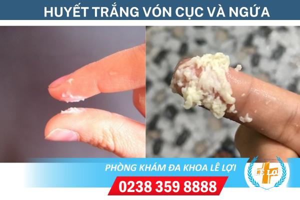 Điểm mặt những bệnh lý gây huyết trắng vón cục và ngứa