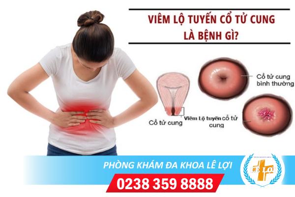 Viêm lộ tuyến cổ tử cung nguy hiểm như thế nào?