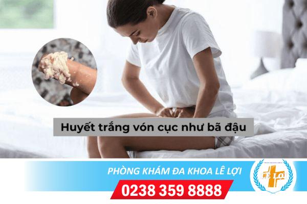 Huyết trắng vón cục như bã đậu ngứa có phải viêm nhiễm phụ khoa